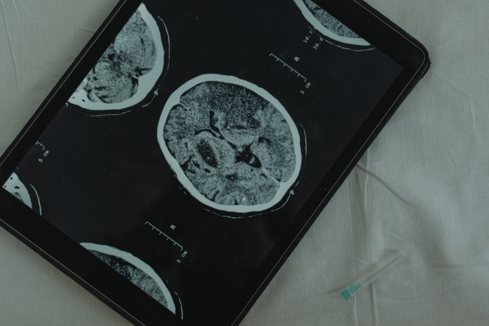 Cerebral Aneurysm Types and When Flow Diverter Placement Is Needed